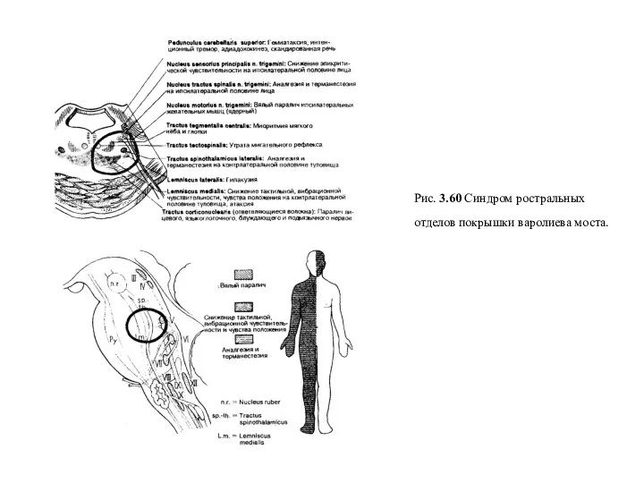 Рис. 3.60 Синдром ростральных отделов покрышки варолиева моста.