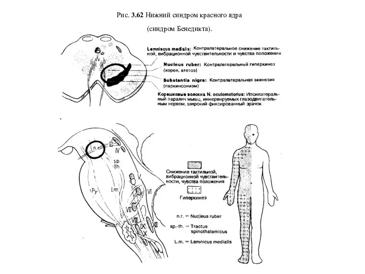 Рис. 3.62 Нижний синдром красного ядра (синдром Бенедикта).