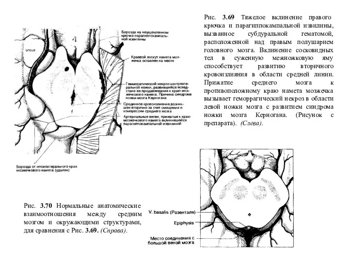 Рис. 3.70 Нормальные анатомические взаимоотношения между средним мозгом и окружающими структурами, для