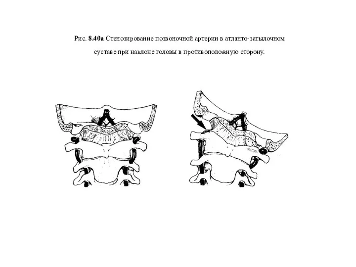 Рис. 8.40а Стенозирование позвоночной артерии в атланто-затылочном суставе при наклоне головы в противоположную сторону.