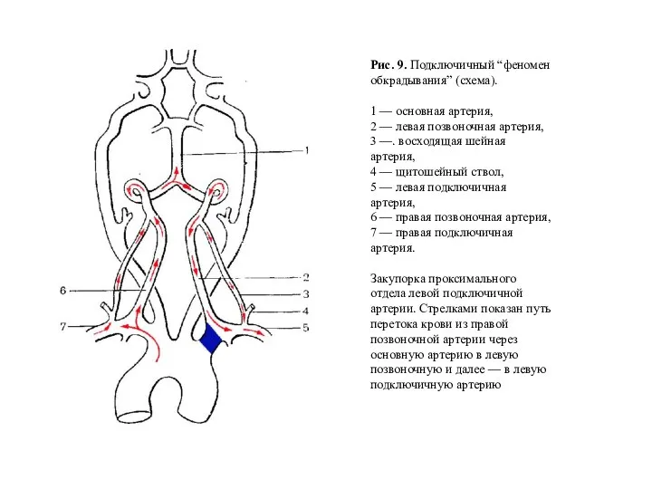 Рис. 9. Подключичный “феномен обкрадывания” (схема). 1 — основная артерия, 2 —