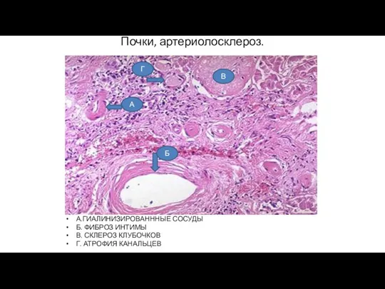 Почки, артериолосклероз. А.ГИАЛИНИЗИРОВАНННЫЕ СОСУДЫ Б. ФИБРОЗ ИНТИМЫ В. СКЛЕРОЗ КЛУБОЧКОВ Г. АТРОФИЯ
