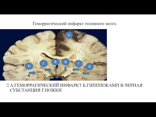 Геморрагический инфаркт головного мозга А.ГЕМОРРАГИЧЕСКИЙ ИНФАРКТ Б.ГИПППОКАМП В.ЧЕРНАЯ СУБСТАНЦИЯ Г.НОЖКИ Г Г