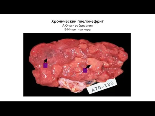 Хронический пиелонефрит А.Очаги рубцевания Б.Интактная кора А Б
