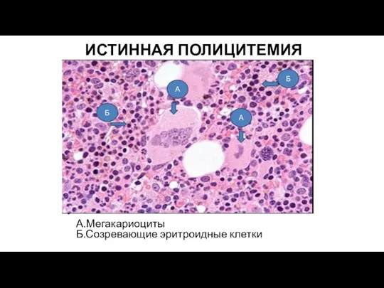 ИСТИННАЯ ПОЛИЦИТЕМИЯ А.Мегакариоциты Б.Созревающие эритроидные клетки А А Б Б