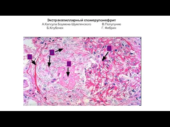 Экстракапиллярный гломерулонефрит А.Капсула Боумена-Шумлянского В.Полулуние Б.Клубочек Г. Фибрин А В Г Б