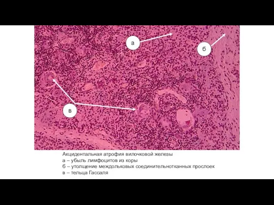 Акцидентальная атрофия вилочковой железы а – убыль лимфоцитов из коры б –