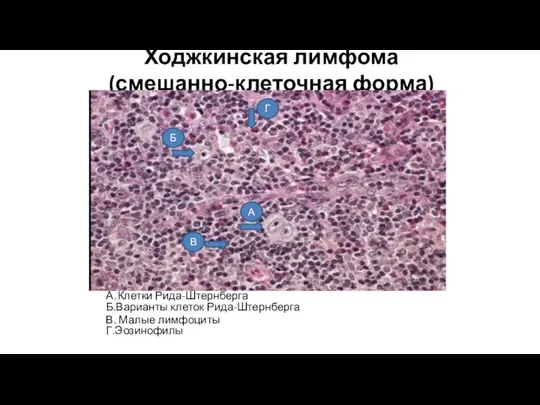 Ходжкинская лимфома (смешанно-клеточная форма) А..Клетки Рида-Штернберга Б.Варианты клеток Рида-Штернберга В. Малые лимфоциты