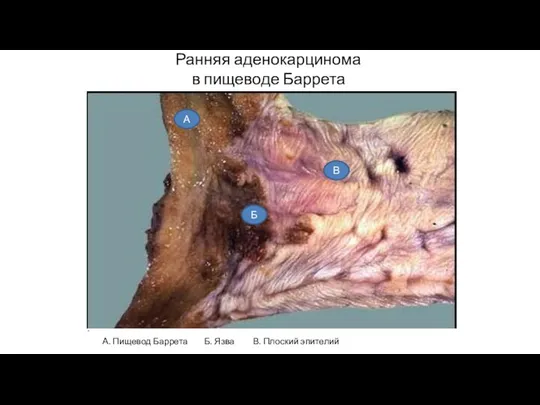 Ранняя аденокарцинома в пищеводе Баррета А. Пищевод Баррета Б. Язва В. Плоский эпителий А Б В