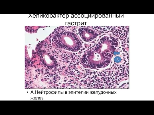 Хеликобактер ассоциированный гастрит А.Нейтрофилы в эпителии желудочных желез А