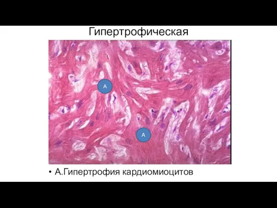 Гипертрофическая кардиомиопатия А.Гипертрофия кардиомиоцитов А А