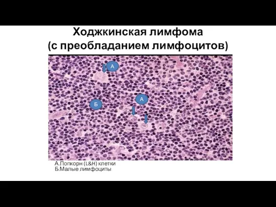 Ходжкинская лимфома (с преобладанием лимфоцитов) А.Попкорн (L&H) клетки Б.Малые лимфоциты А А Б