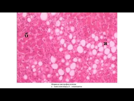 Жировая дистрофия печени а – капельки жира, б – гепатоциты