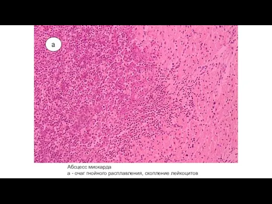 Абсцесс миокарда а - очаг гнойного расплавления, скопление лейкоцитов