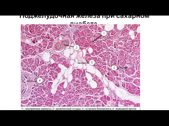 Поджелудочная железа при сахарном диабете.