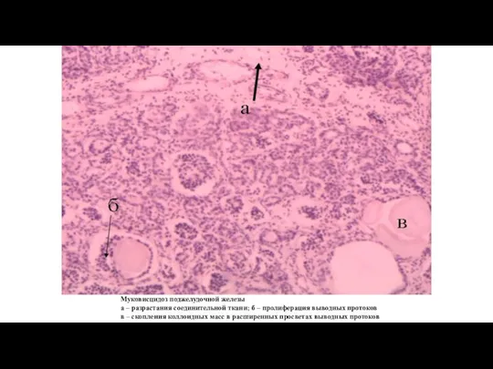 Муковисцидоз поджелудочной железы а – разрастания соединительной ткани; б – пролиферация выводных