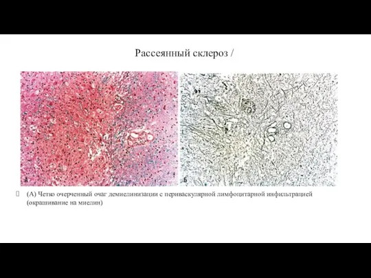 Рассеянный склероз / (А) Четко очерченный очаг демиелинизации с периваскулярной лимфоцитарной инфильтрацией (окрашивание на миелин)