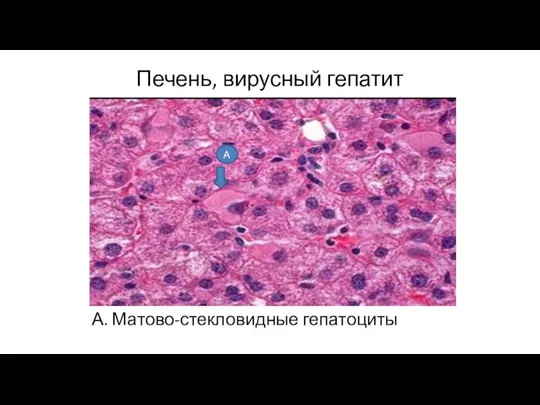 Печень, вирусный гепатит А. Матово-стекловидные гепатоциты А