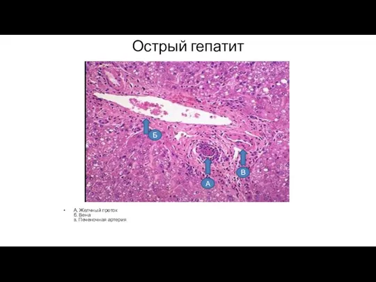 Острый гепатит А. Желчный проток б. Вена в. Печеночная артерия В А Б