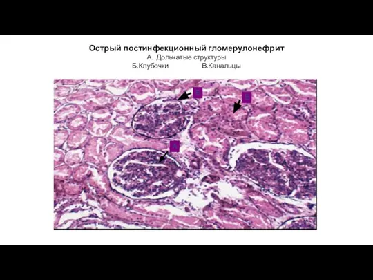 Острый постинфекционный гломерулонефрит А. Дольчатые структуры Б.Клубочки В.Канальцы А Б В