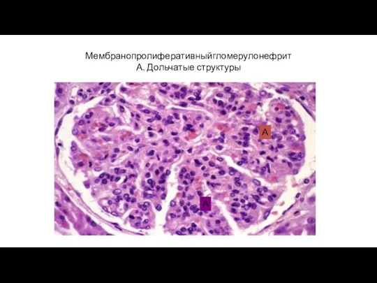 Мембранопролиферативныйгломерулонефрит А. Дольчатые структуры А А