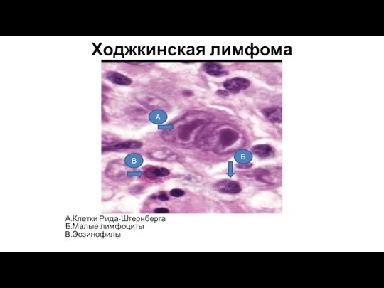 Ходжкинская лимфома А.Клетки Рида-Штернберга Б.Малые лимфоциты В.Эозинофилы В Б А