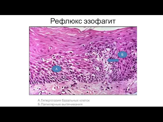 Рефлюкс эзофагит А.Гиперплазия базальных клеток Б.Папилярные выпячивания А Б