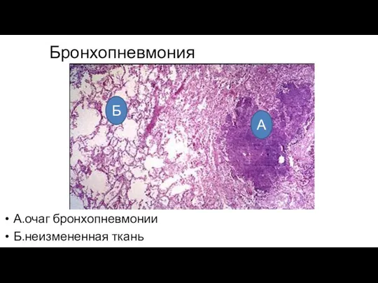 Бронхопневмония А.очаг бронхопневмонии Б.неизмененная ткань Б А