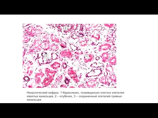 Некротический нефроз. 1-Кариолизис, плазморексис клеткок эпителия извитых канальцев. 2 – клубочек, 3