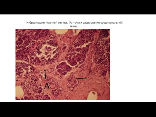Фиброз поджелудочной железы (А – очаги разрастания соединительной ткани)