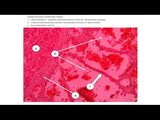 Кавернознозная гемангиома печени а – ткань печени;б – каверны (многочисленные полости, заполненные