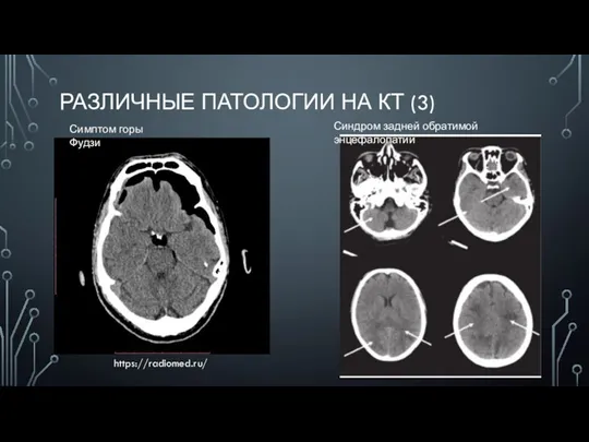 РАЗЛИЧНЫЕ ПАТОЛОГИИ НА КТ (3) Симптом горы Фудзи https://radiomed.ru/ Синдром задней обратимой энцефалопатии