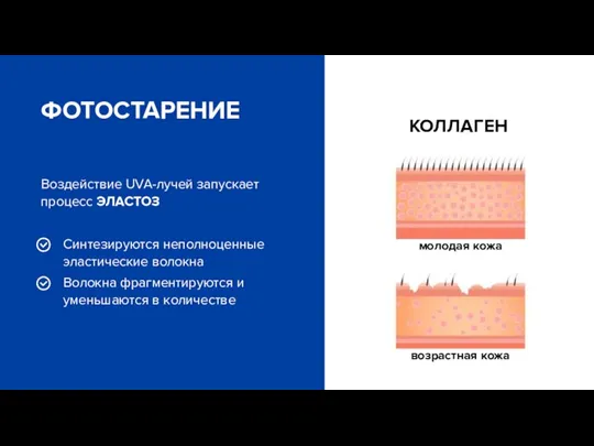 Воздействие UVA-лучей запускает процесс ЭЛАСТОЗ Синтезируются неполноценные эластические волокна Волокна фрагментируются и