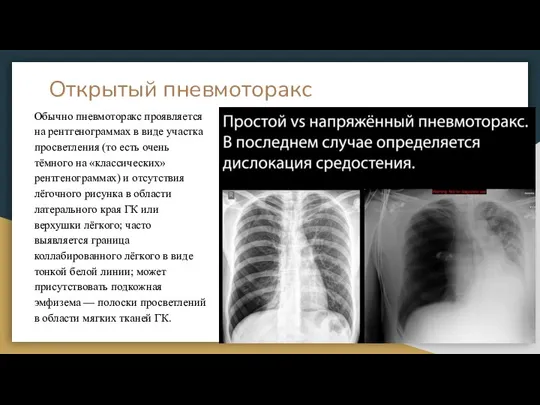 Открытый пневмоторакс Обычно пневмоторакс проявляется на рентгенограммах в виде участка просветления (то