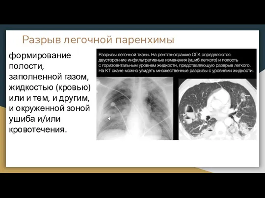 Разрыв легочной паренхимы формирование полости, заполненной газом, жидкостью (кровью) или и тем,