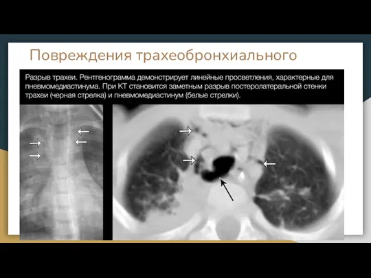 Повреждения трахеобронхиального дерева