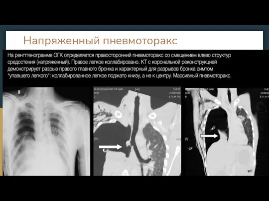 Напряженный пневмоторакс