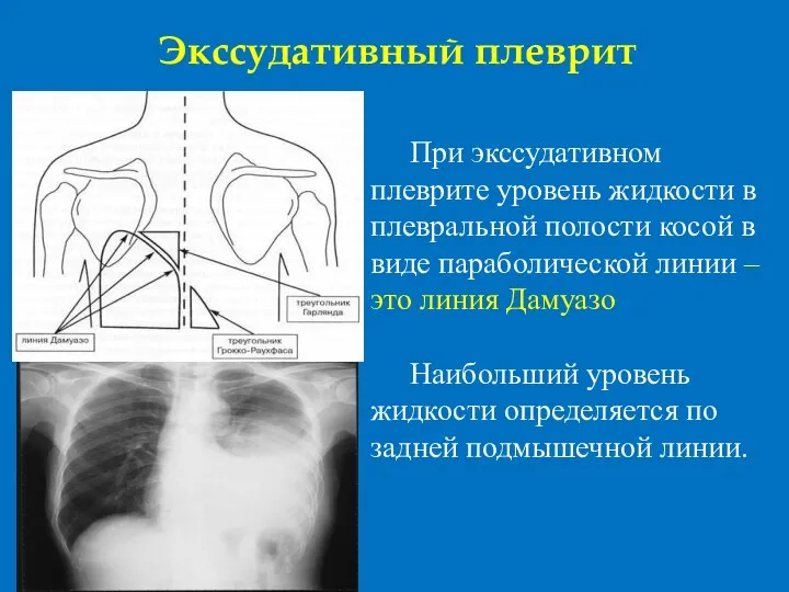 Экссудативный плеврит При экссудативном плеврите уровень жидкости в плевральной полости косой в