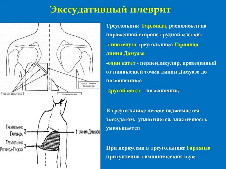 Экссудативный плеврит Треугольник Гарлянда, расположен на пораженной стороне грудной клетки: -гипотенуза треугольника