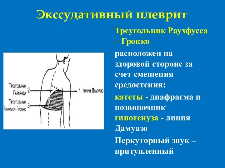 Экссудативный плеврит Треугольник Раухфусса – Грокко расположен на здоровой стороне за счет