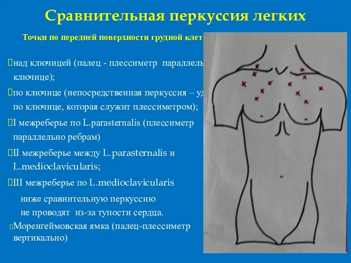 Сравнительная перкуссия легких Точки по передней поверхности грудной клетки : над ключицей