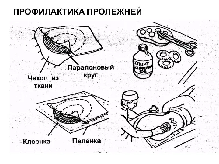 ПРОФИЛАКТИКА ПРОЛЕЖНЕЙ