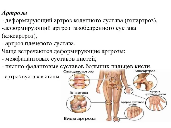 Артрозы - деформирующий артроз коленного сустава (гонартроз), -деформирующий артроз тазобедренного сустава (коксартроз),