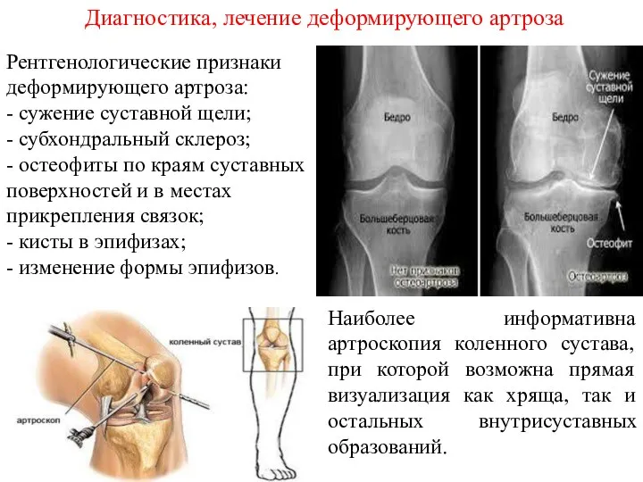 Диагностика, лечение деформирующего артроза Рентгенологические признаки деформирующего артроза: - сужение суставной щели;