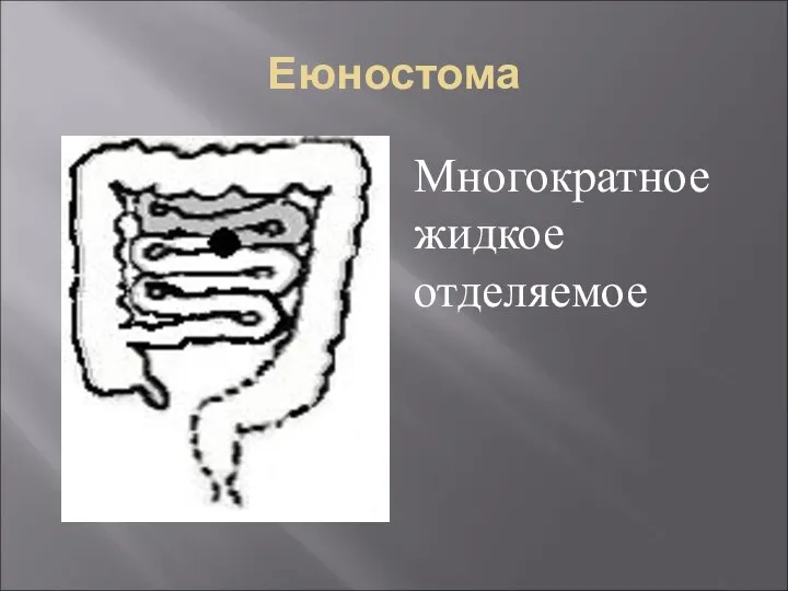 Еюностома Многократное жидкое отделяемое