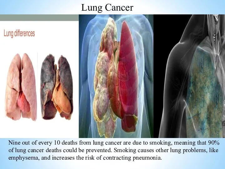 Lung Cancer Nine out of every 10 deaths from lung cancer are