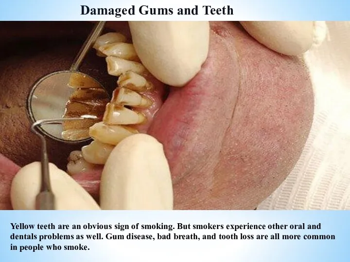 Damaged Gums and Teeth Yellow teeth are an obvious sign of smoking.