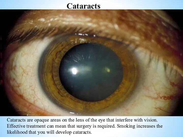 Cataracts Cataracts are opaque areas on the lens of the eye that