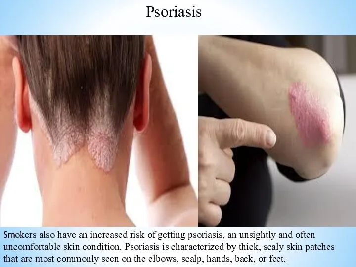 Psoriasis Smokers also have an increased risk of getting psoriasis, an unsightly