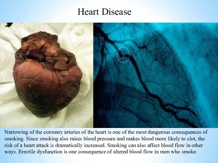 Heart Disease Narrowing of the coronary arteries of the heart is one